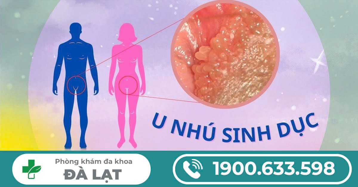 CÁCH CHỮA U NHÚ SINH DỤC